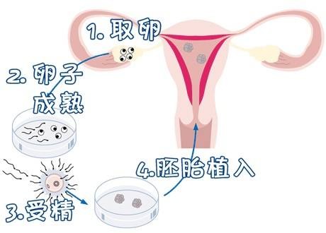 女同伴侣借卵代怀